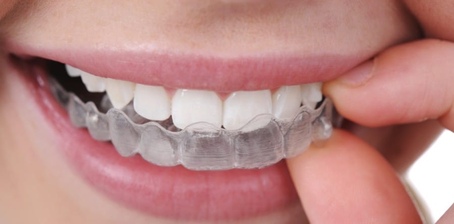 Aparatul dentar Invisalign