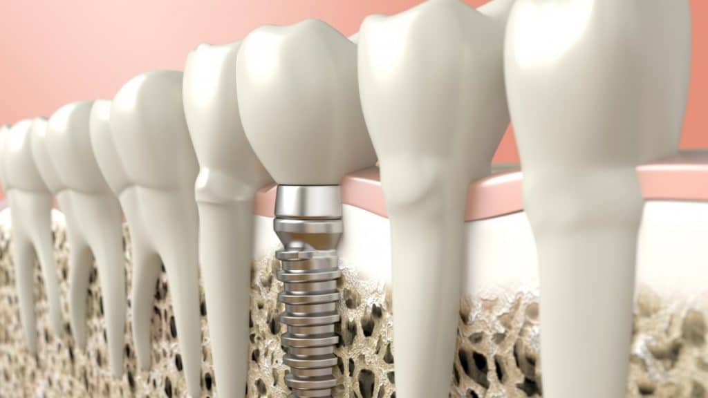 recomandari dupa implant dentar